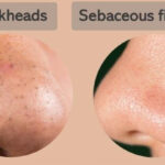 Blackhead or Sebaceous Filament?